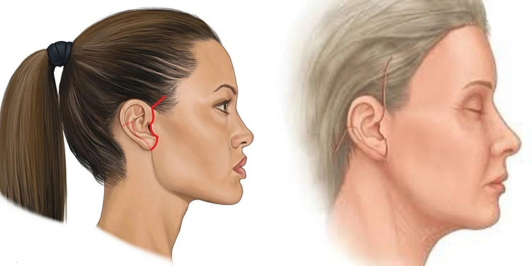 Phẫu thuật Căng da mặt SMAS có nguy hiểm không?