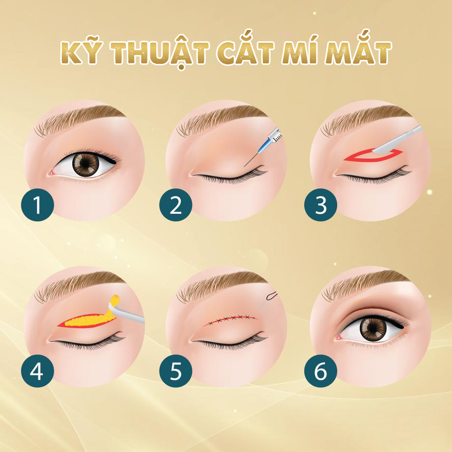Cắt mí và những điều cần lưu ý trước khi cắt mí 2