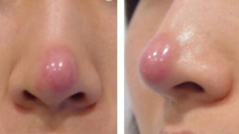 4 dấu hiệu nhận biết mũi hỏng